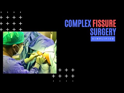 Complex Fissure Surgery Simplified