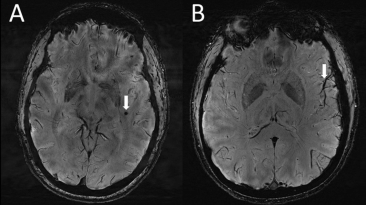 This Is Your Brain With a Migraine