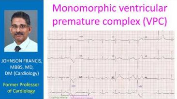 Monomorphic ventricular premature complex (VPC)