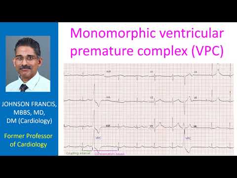 Monomorphic ventricular premature complex (VPC)