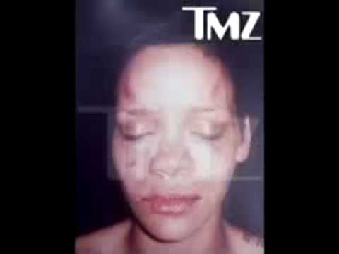 BREAKING NEWS: Rihanna bruised and beaten photos Leaked. TMZ