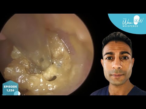 1,226 – Complex & Challenging Ear Wax Removal