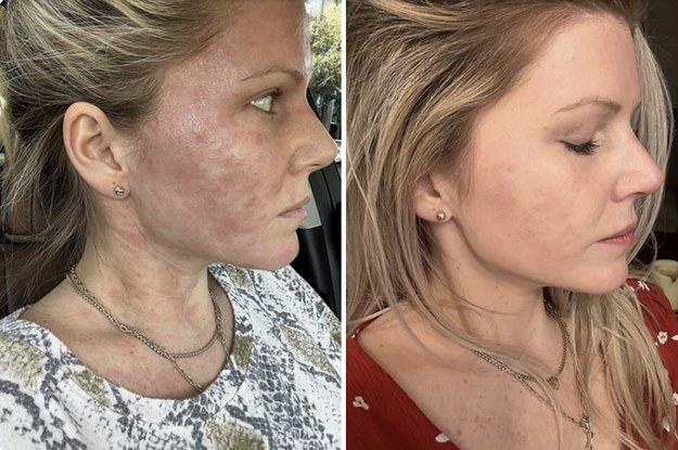 27 Skincare Products With Before & After Photos So Dramatic, We Made Them Click To Reveal