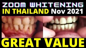 Zoom Teeth Whitening Phuket Thailand