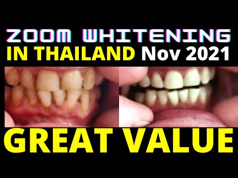 Zoom Teeth Whitening Phuket Thailand