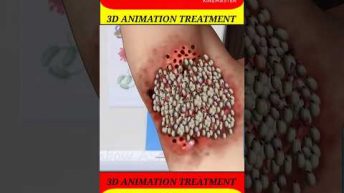 ज़ख्मी घाव का |3D ANIMATION TREATMENT #shots #viral #trending #asmr #yotubeshorts@MrBeast