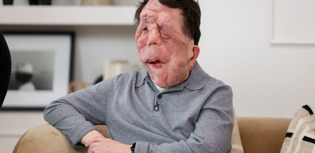 “A Different Man” Star Adam Pearson Opened Up About The “Lazy” Way Actors With Disabilities Are Portrayed In Hollywood