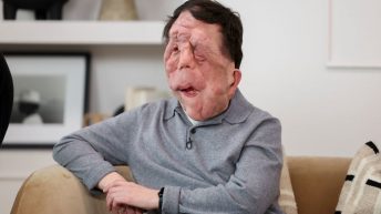 “A Different Man” Star Adam Pearson Opened Up About The “Lazy” Way Actors With Disabilities Are Portrayed In Hollywood