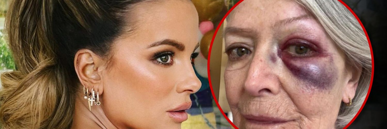 Kate Beckinsale Sparks Concern After Posting Photo of Mom with Bruised Eye