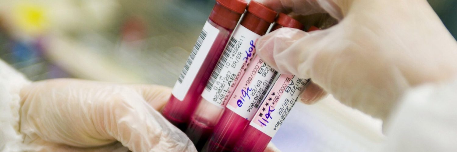 Blood Test Shows Promise for Alzheimer’s Diagnosis